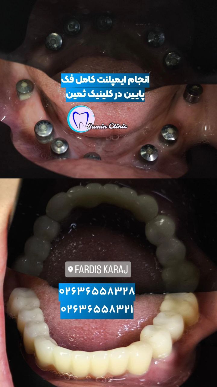 ایمپلنت دندان 2